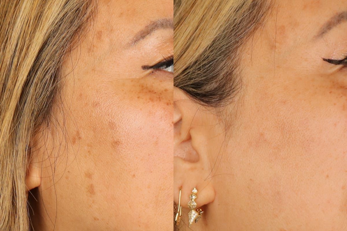MOXI Laser Treatment Before & After Gallery - Patient 107573 - Image 1