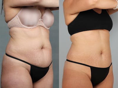 CoolSculpting Before & After Gallery - Patient 390496 - Image 1
