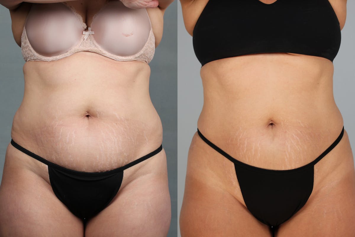 CoolSculpting Before & After Gallery - Patient 390496 - Image 2
