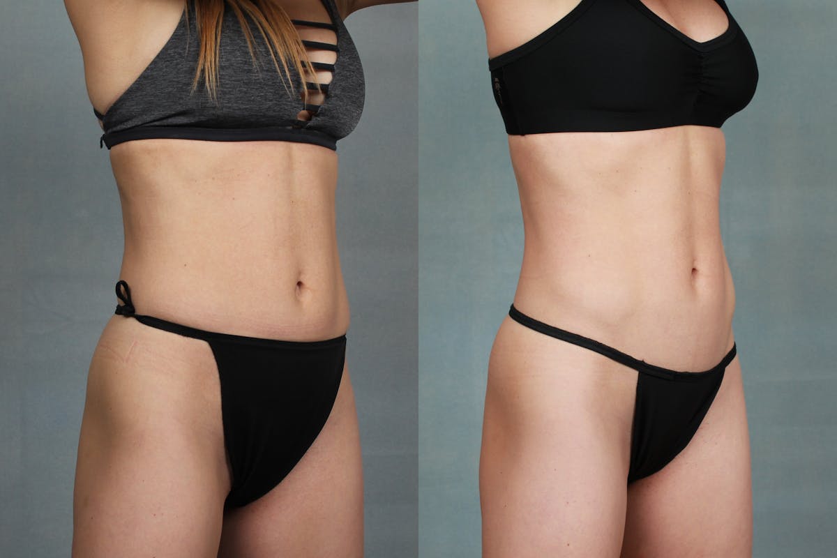 EMSculpt Before & After Gallery - Patient 347859 - Image 2