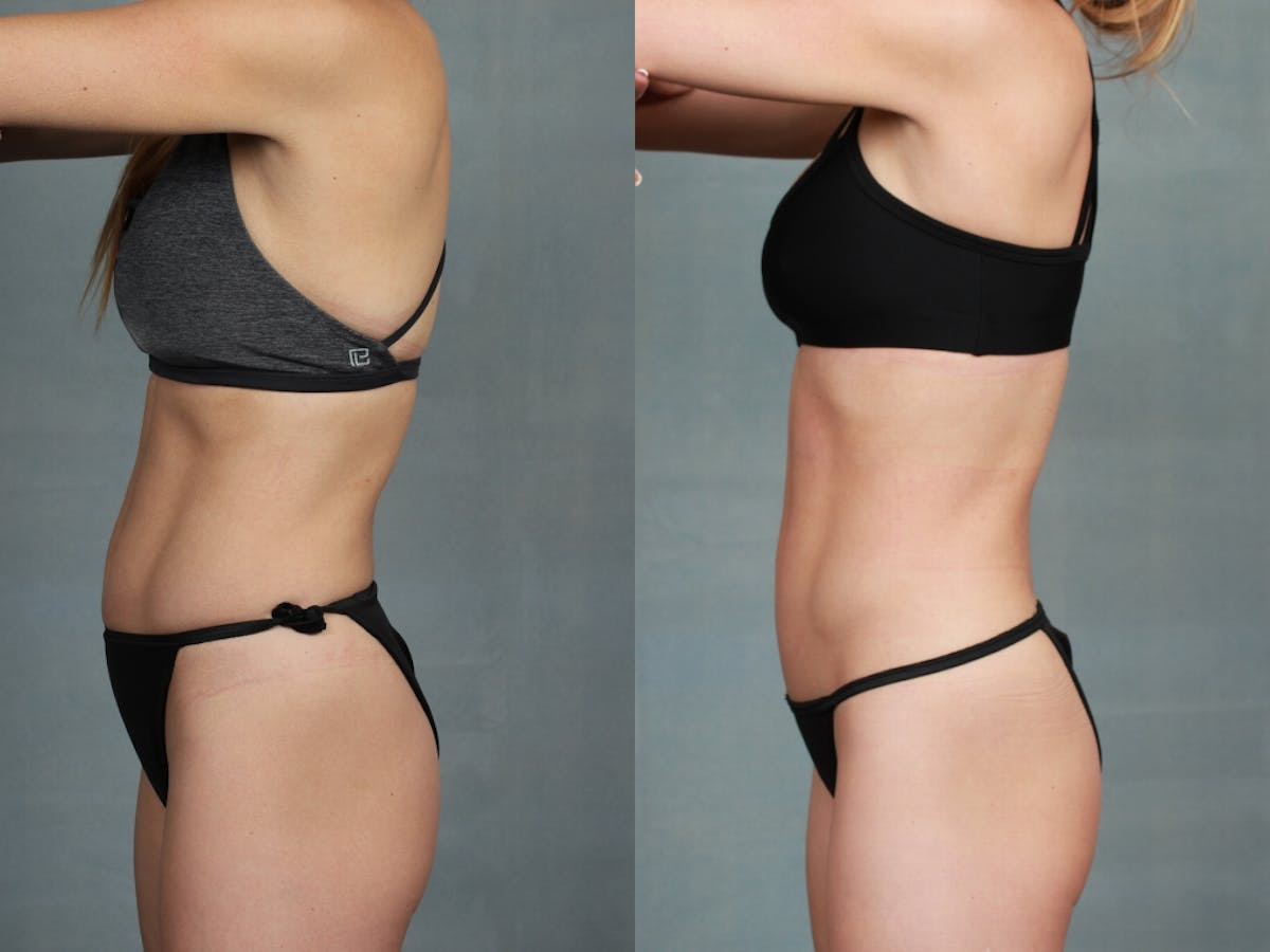 EMSculpt Before & After Gallery - Patient 347859 - Image 1