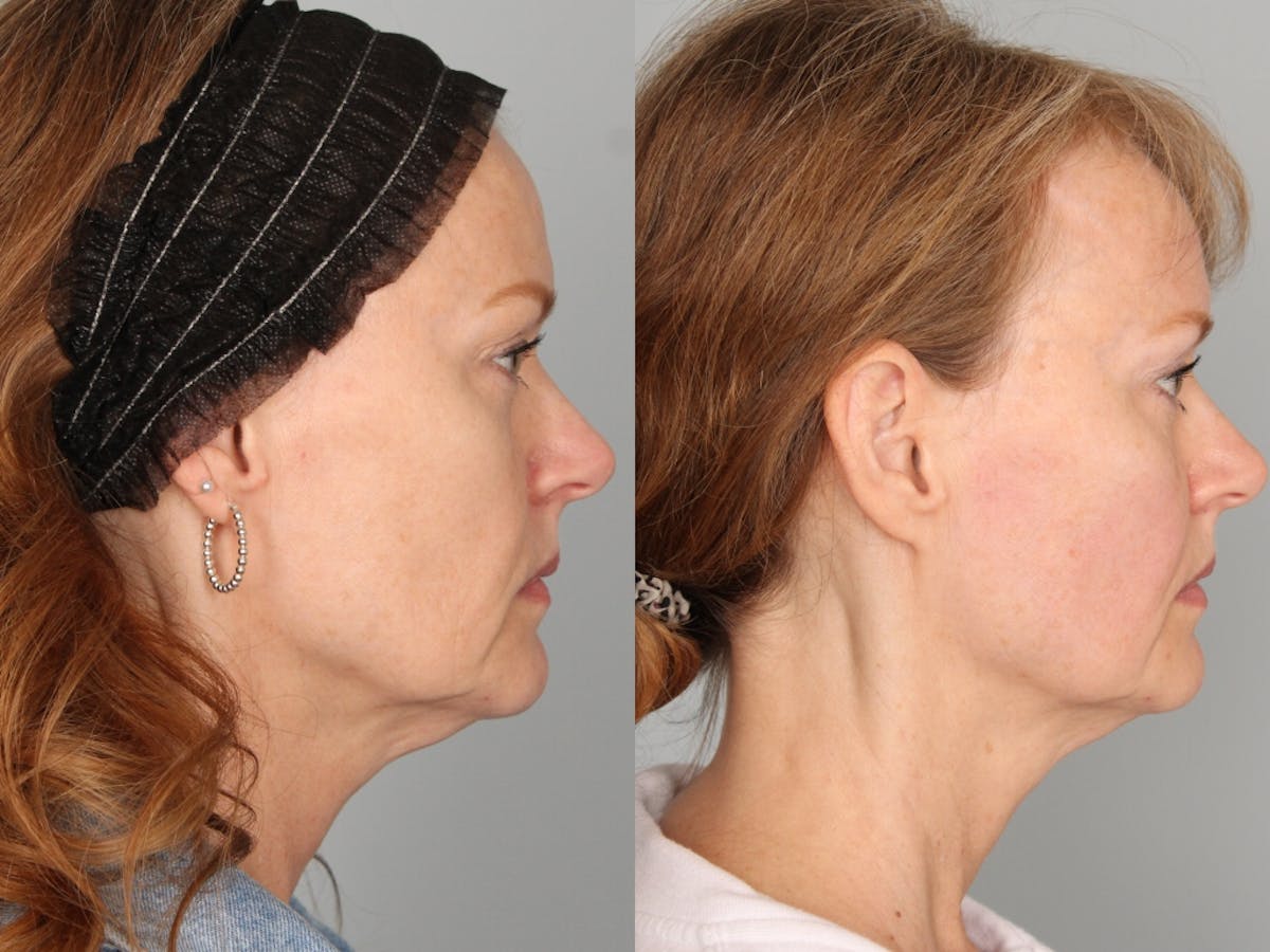 EmFace Before & After Gallery - Patient 264780 - Image 2