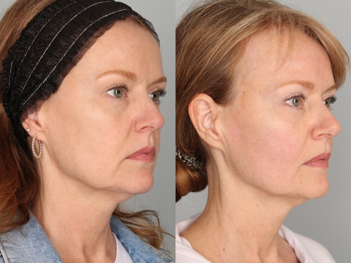 EmFace Before & After Gallery - Patient 264780 - Image 1