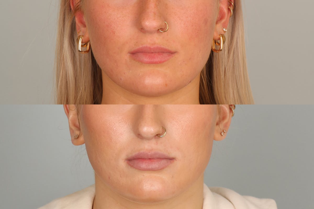 Dermal Fillers Before & After Gallery - Patient 379333 - Image 2