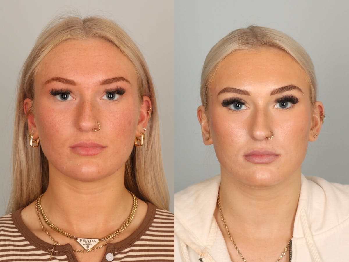 Dermal Fillers Before & After Gallery - Patient 379333 - Image 1