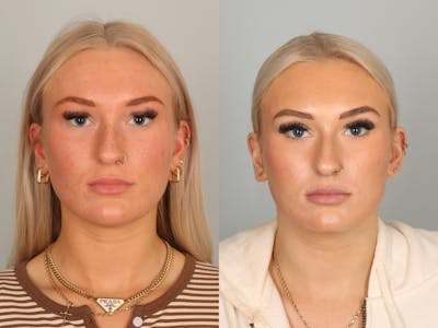Dermal Fillers Before & After Gallery - Patient 379333 - Image 1