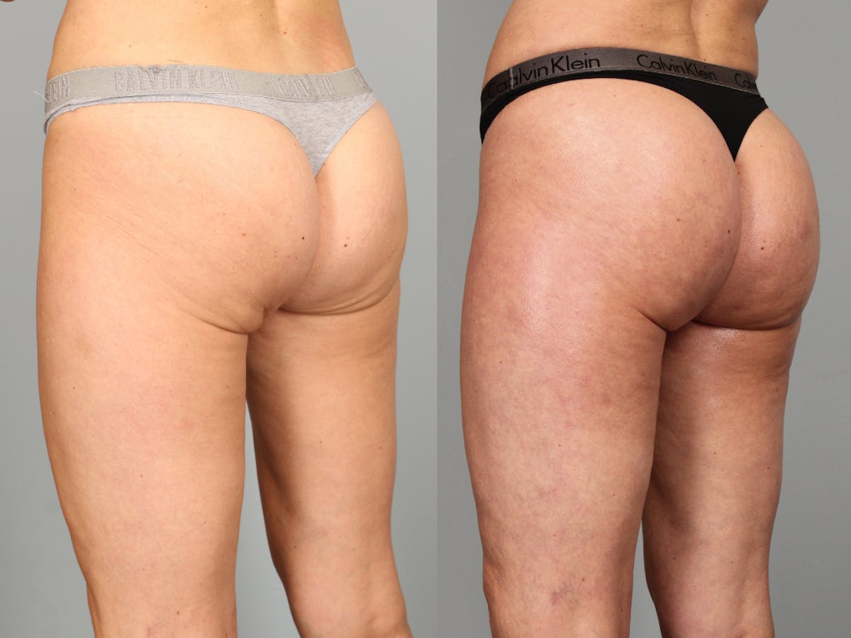 Dermal Fillers Before & After Gallery - Patient 301645 - Image 1