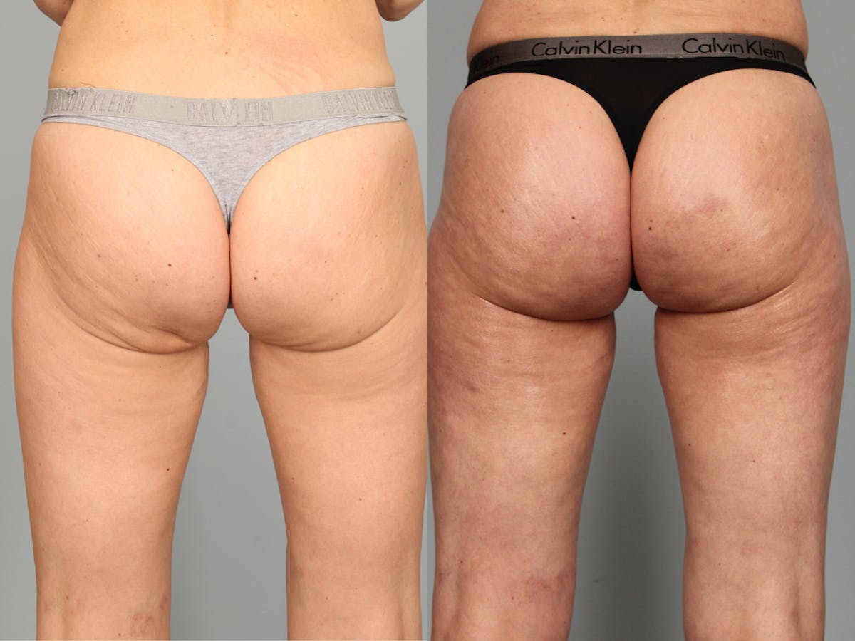 Dermal Fillers Before & After Gallery - Patient 301645 - Image 2