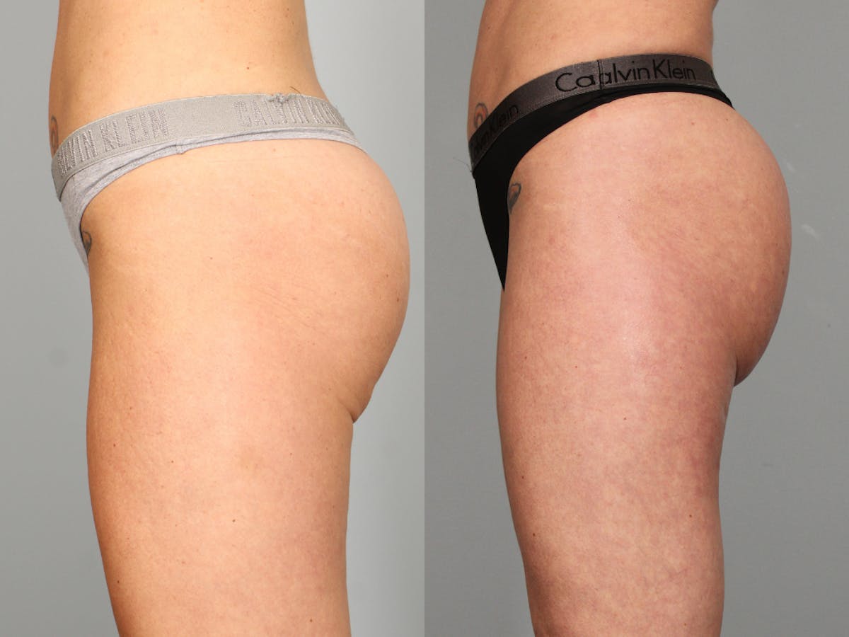 Dermal Fillers Before & After Gallery - Patient 301645 - Image 3