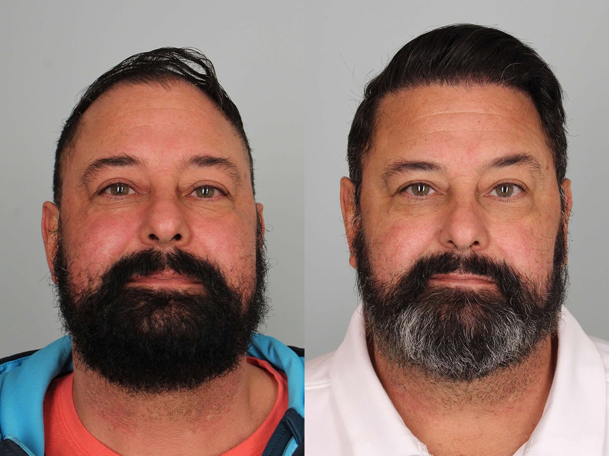 Hair Restoration Before & After Gallery - Patient 338998 - Image 1