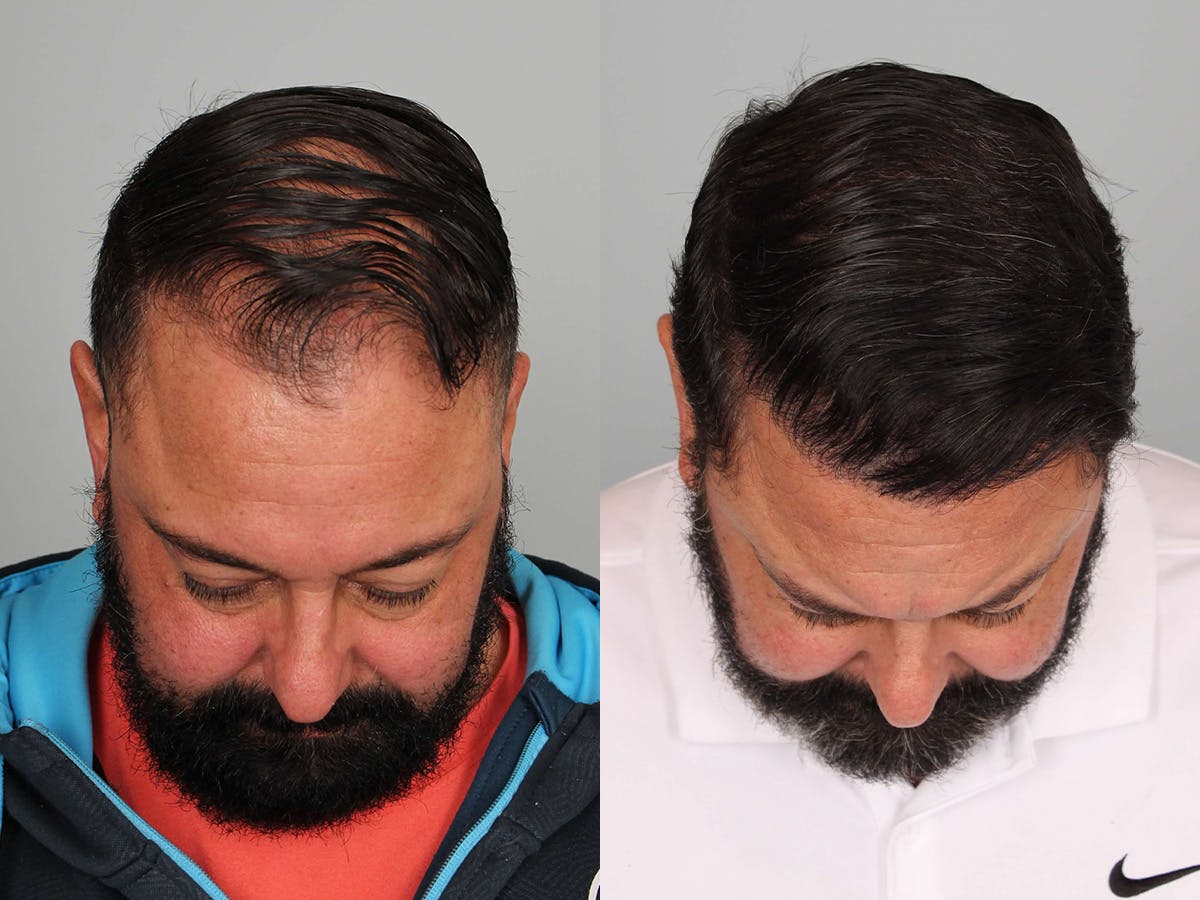 Hair Restoration Before & After Gallery - Patient 338998 - Image 2