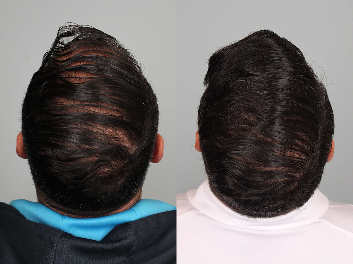 Hair Restoration Before & After Gallery - Patient 338998 - Image 3