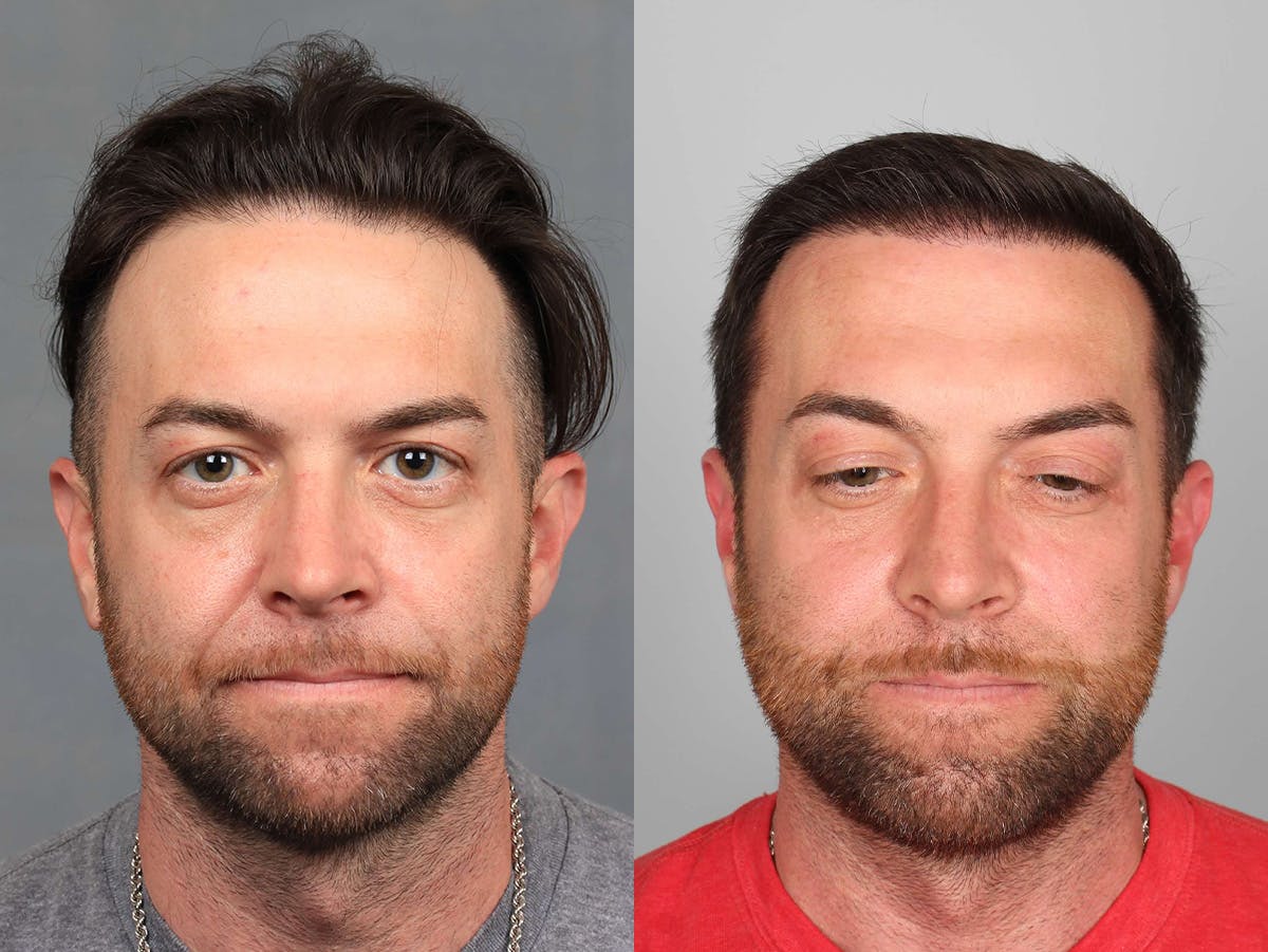 NeoGraft Before & After Gallery - Patient 218408 - Image 1