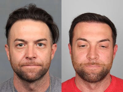 NeoGraft Before & After Gallery - Patient 218408 - Image 1