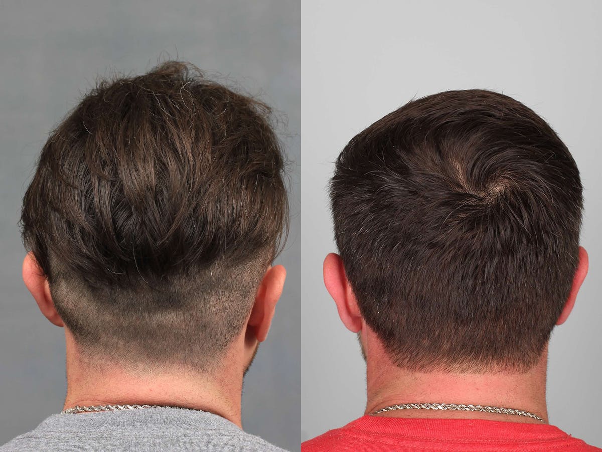 NeoGraft Before & After Gallery - Patient 218408 - Image 3
