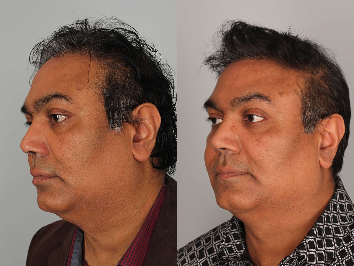 NeoGraft Before & After Gallery - Patient 300822 - Image 2