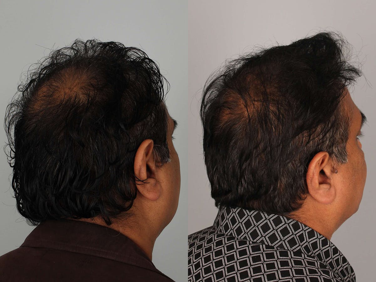 NeoGraft Before & After Gallery - Patient 300822 - Image 3