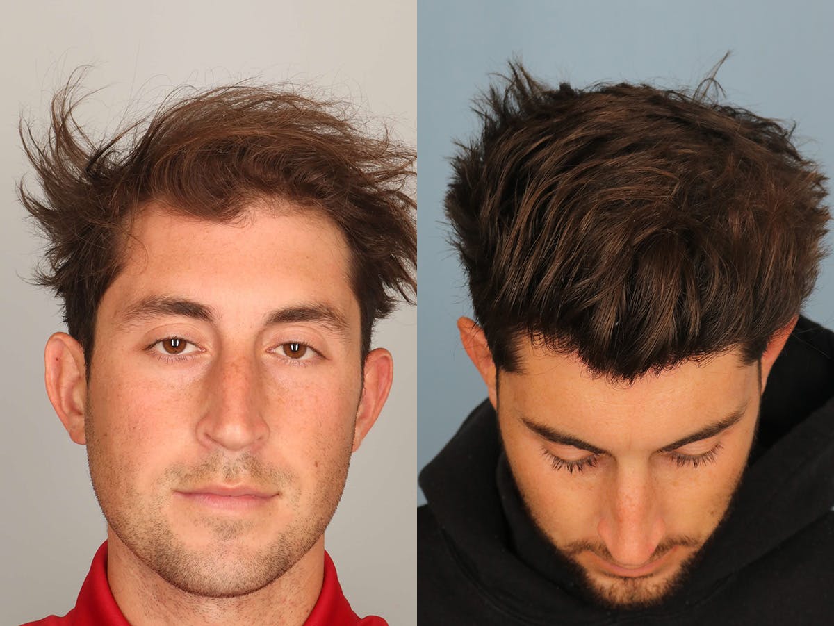 NeoGraft Before & After Gallery - Patient 293639 - Image 1