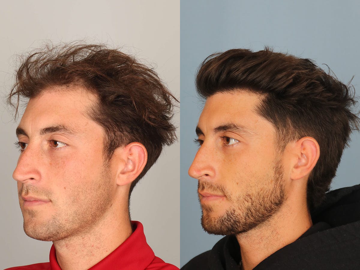 NeoGraft Before & After Gallery - Patient 293639 - Image 2