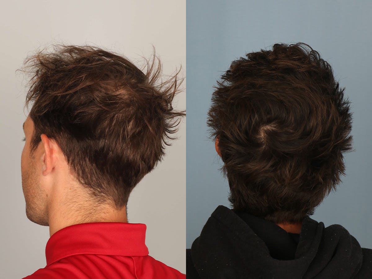 NeoGraft Before & After Gallery - Patient 293639 - Image 3