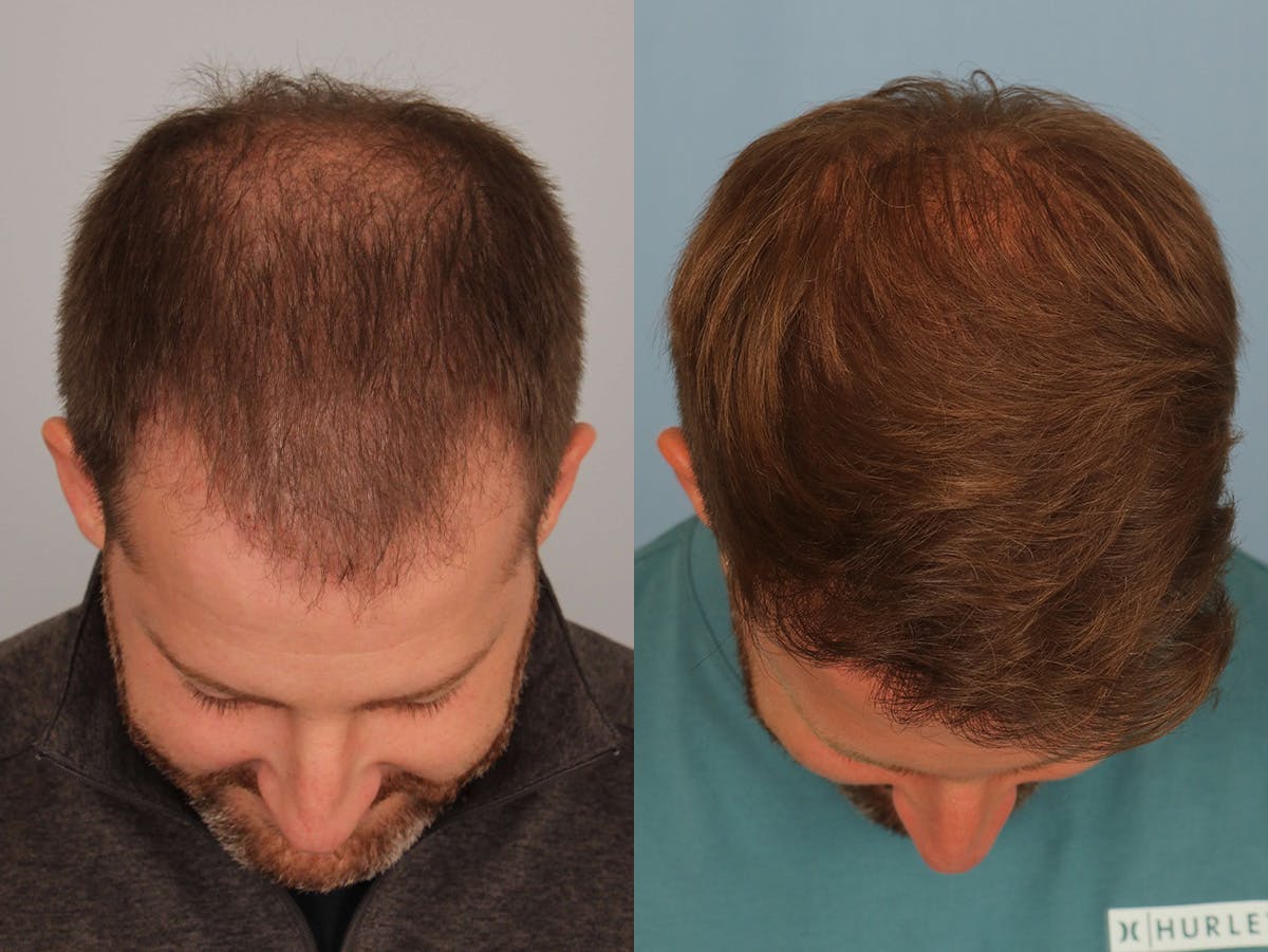 NeoGraft Before & After Gallery - Patient 138720 - Image 2