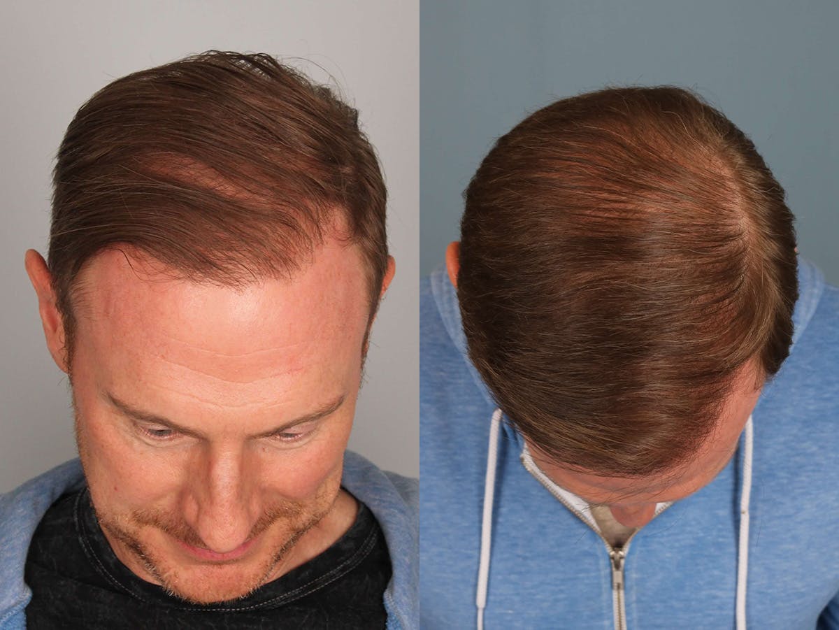 NeoGraft Before & After Gallery - Patient 308293 - Image 3