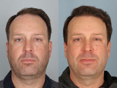 NeoGraft Before & After Gallery - Patient 375559 - Image 1