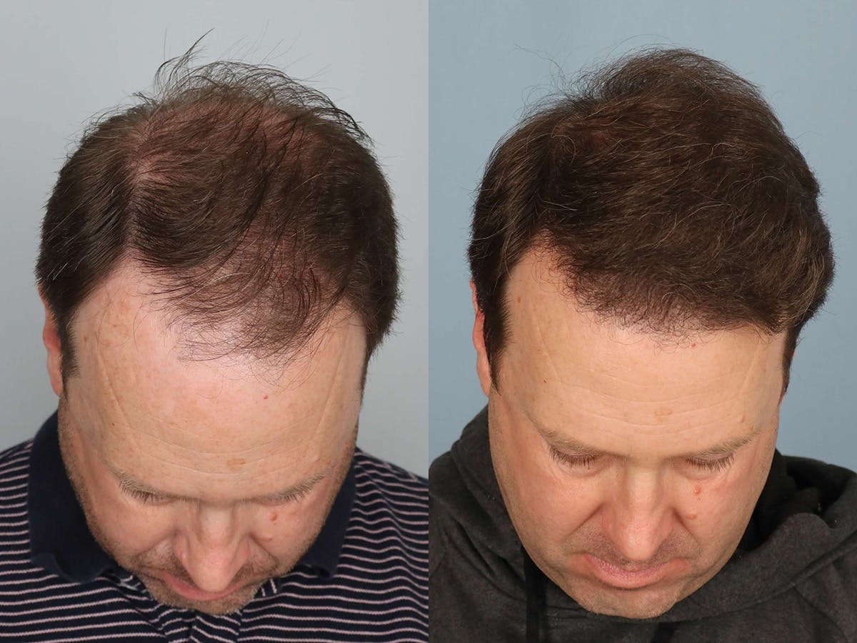 NeoGraft Before & After Gallery - Patient 375559 - Image 3