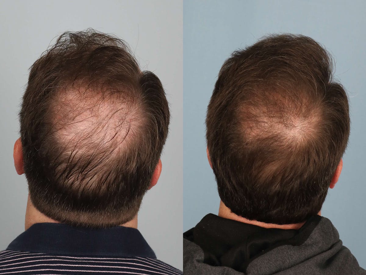 NeoGraft Before & After Gallery - Patient 375559 - Image 2