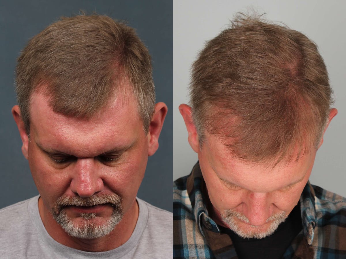 NeoGraft Before & After Gallery - Patient 328439 - Image 1