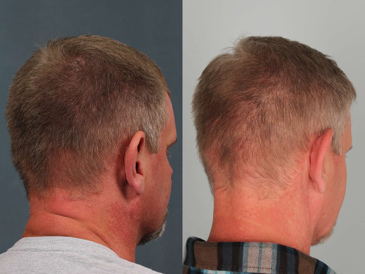 NeoGraft Before & After Gallery - Patient 328439 - Image 3