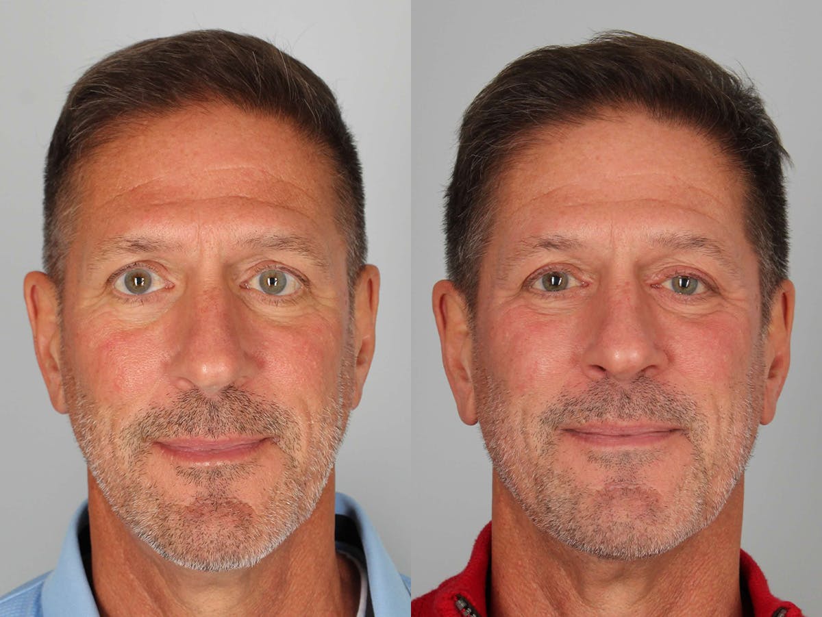 NeoGraft Before & After Gallery - Patient 301861 - Image 1