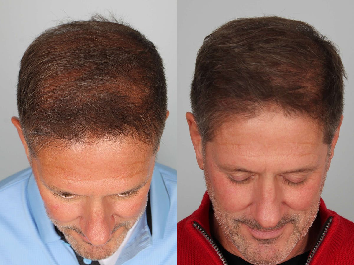 NeoGraft Before & After Gallery - Patient 301861 - Image 2