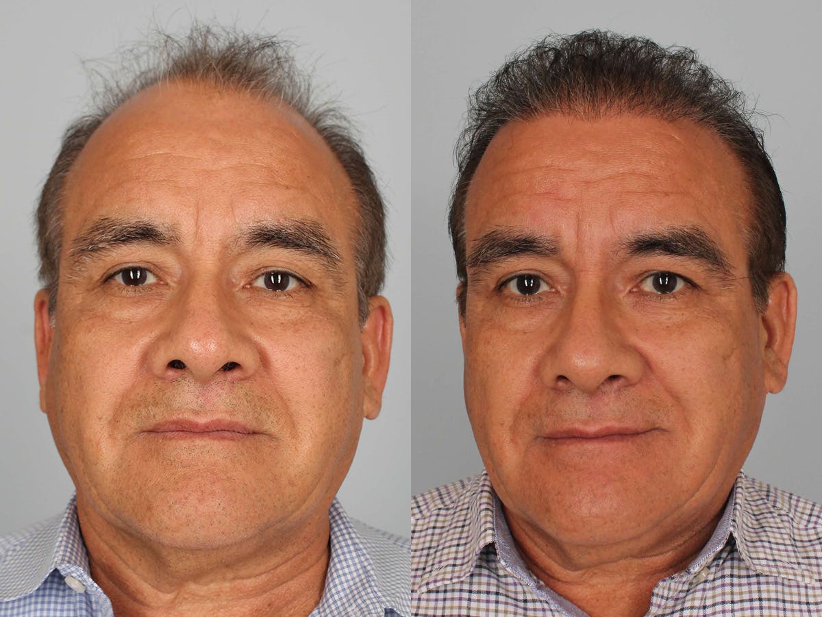 NeoGraft Before & After Gallery - Patient 241916 - Image 1