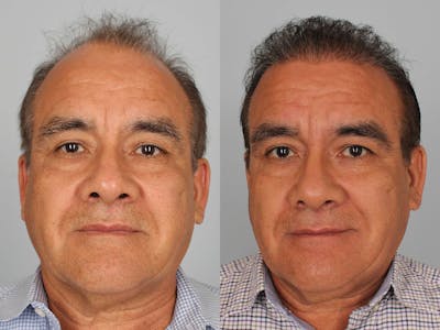 NeoGraft Before & After Gallery - Patient 241916 - Image 1