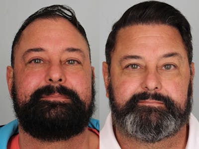 NeoGraft Before & After Gallery - Patient 144613 - Image 1