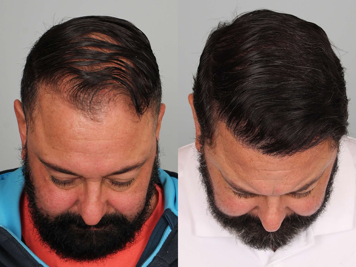 NeoGraft Before & After Gallery - Patient 144613 - Image 2