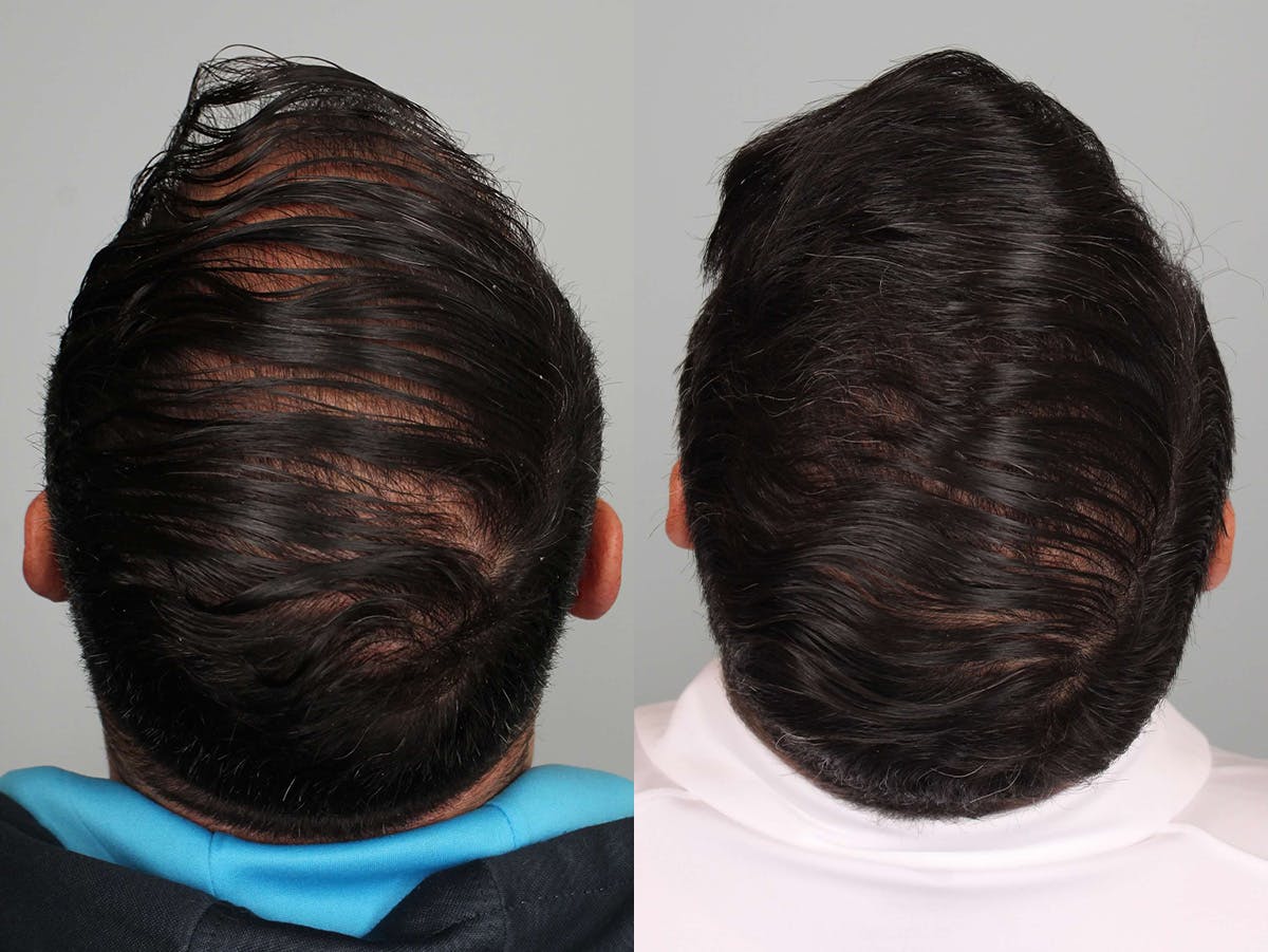 NeoGraft Before & After Gallery - Patient 144613 - Image 3