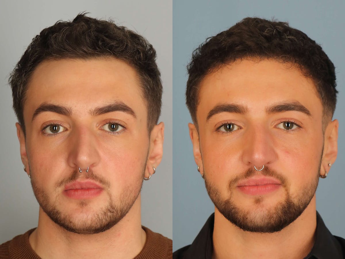 NeoGraft Before & After Gallery - Patient 210714 - Image 1