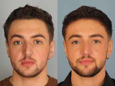 NeoGraft Before & After Gallery - Patient 210714 - Image 1