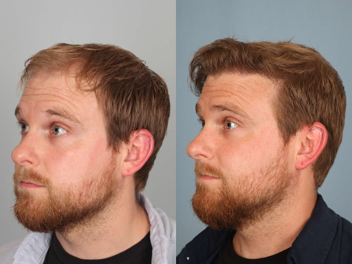 NeoGraft Before & After Gallery - Patient 374478 - Image 2