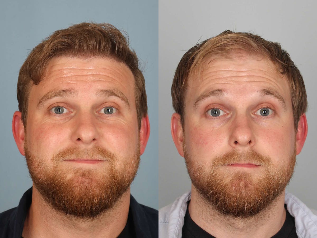 NeoGraft Before & After Gallery - Patient 374478 - Image 1