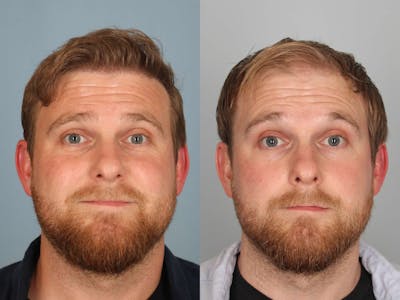 NeoGraft Before & After Gallery - Patient 374478 - Image 1