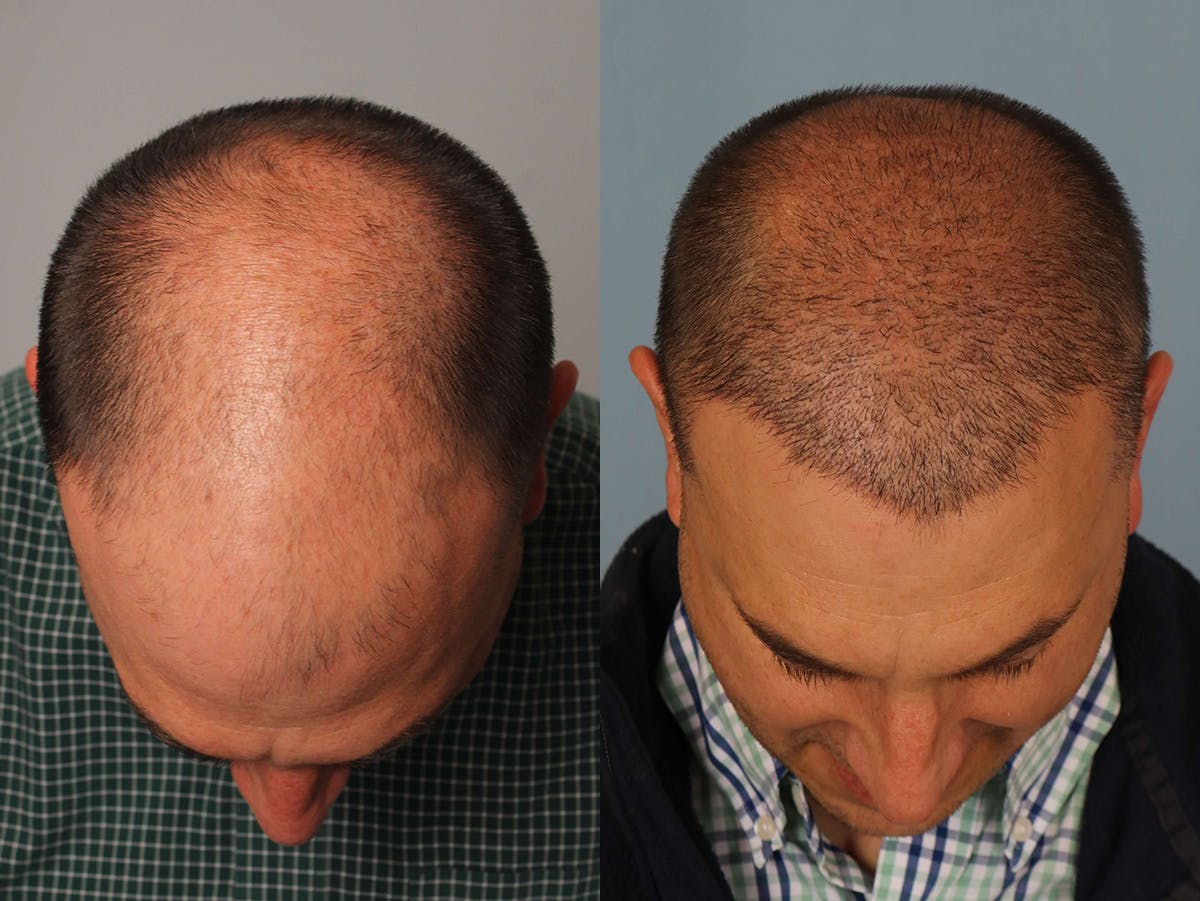 NeoGraft Before & After Gallery - Patient 185046 - Image 1
