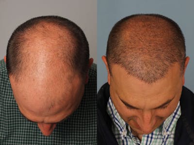 NeoGraft Before & After Gallery - Patient 185046 - Image 1