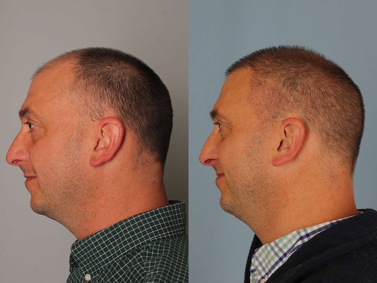 NeoGraft Before & After Gallery - Patient 185046 - Image 3