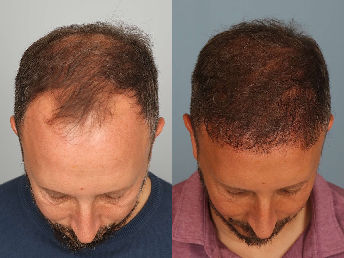 NeoGraft Before & After Gallery - Patient 260144 - Image 3