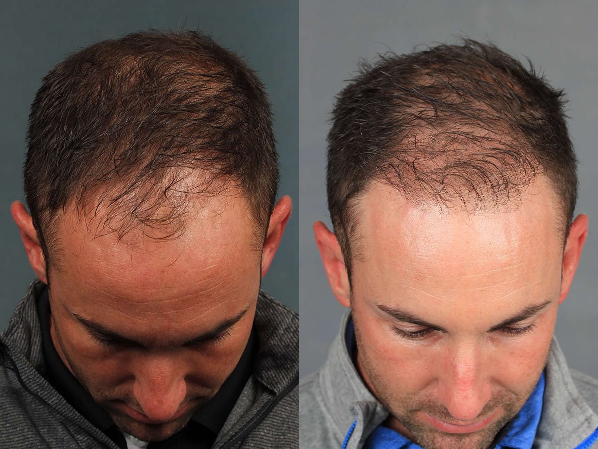 NeoGraft Before & After Gallery - Patient 103497 - Image 2