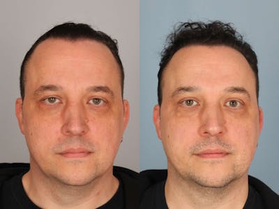 NeoGraft Before & After Gallery - Patient 354347 - Image 1