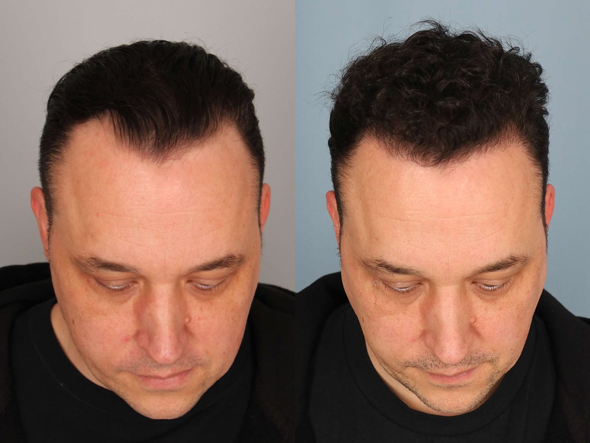NeoGraft Before & After Gallery - Patient 354347 - Image 2